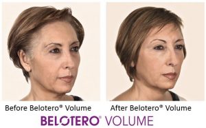 Belotero Volume